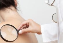 4 preguntas que debe conocer sobre el cáncer de piel