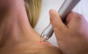 ¿Qué tipo de lunares se pueden quitar con láser? Eliminación de lunares con láser