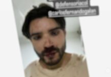 Grave denuncia de Homofobia: Joven atacado por Conductores del SITP en Kennedy, le dejaron varias fracturas Edward Leonardo Rodríguez ataque homofóbico SITP